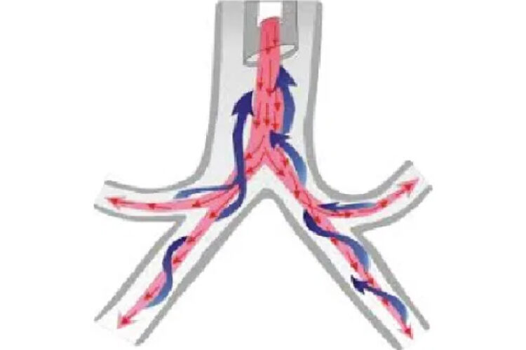 ENDOBRONCHIAL LASER