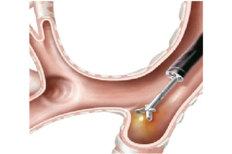 ENDOBRONCHIAL TAMPONADING