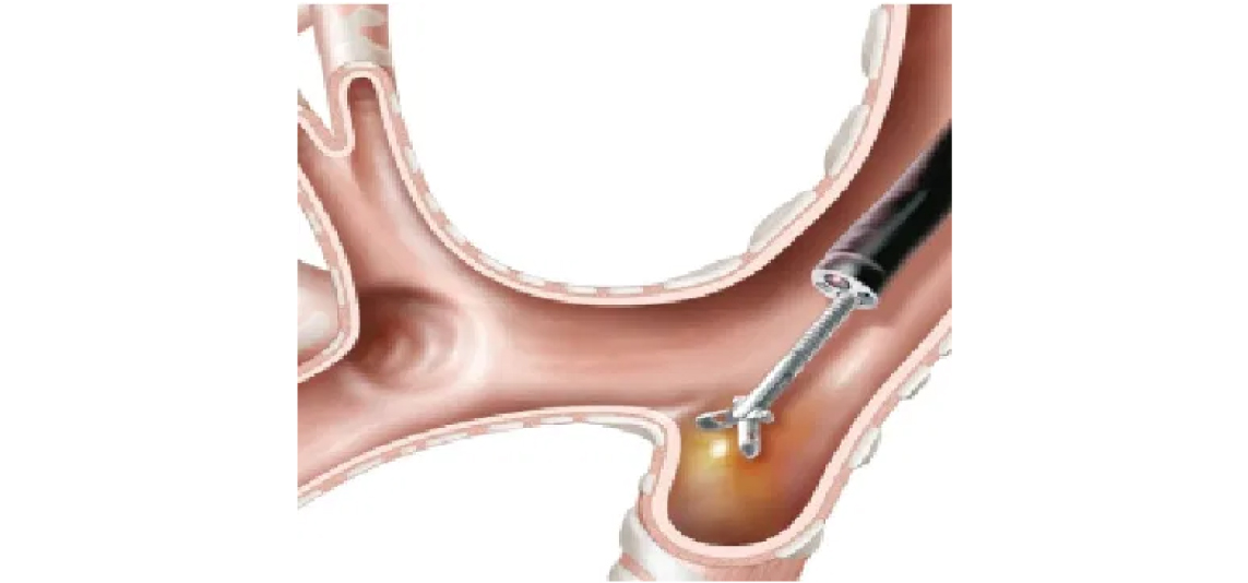 ENDOBRONCHIAL TAMPONADING