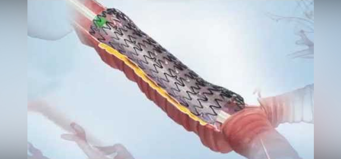 TRACHEOBRONCHIAL STENTING