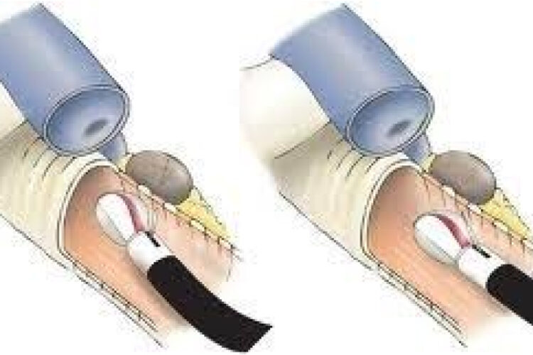 TRANSBRONCHIAL NEEDLE ASPIRATION