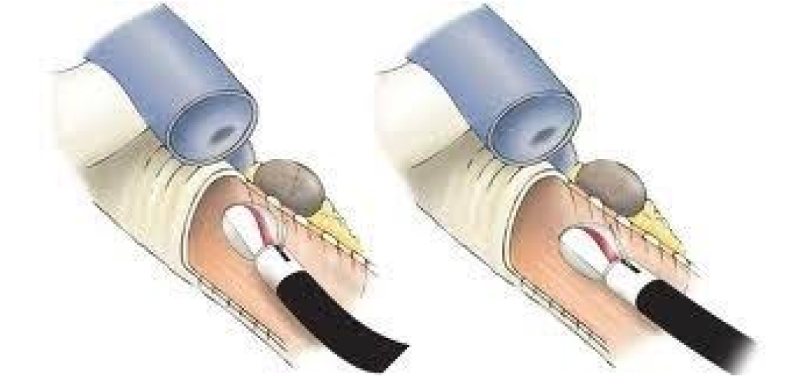 TRANSBRONCHIAL NEEDLE ASPIRATION