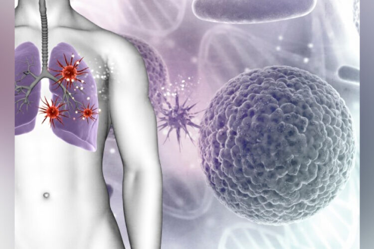 Lung Cancer