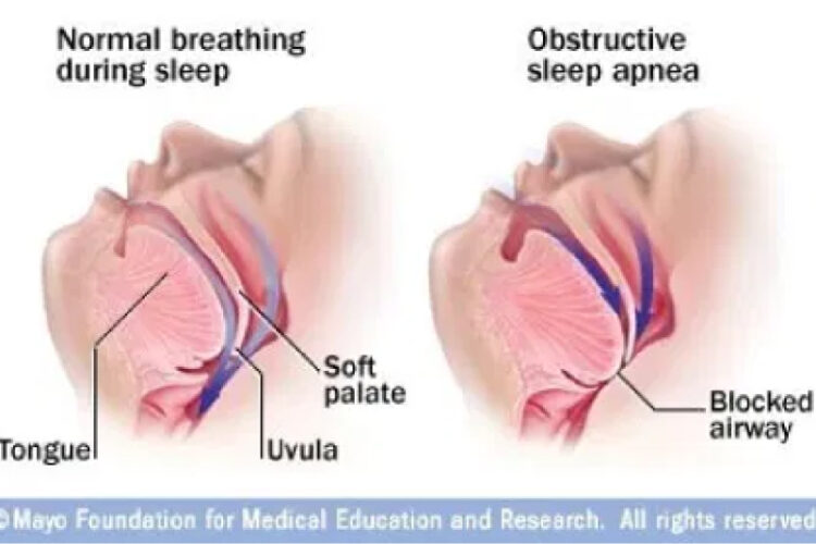 SLEEP APNEA