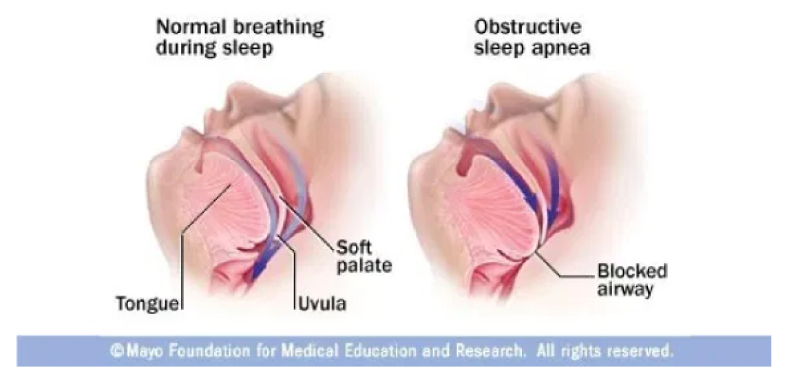 SLEEP APNEA SLEEP APNEA