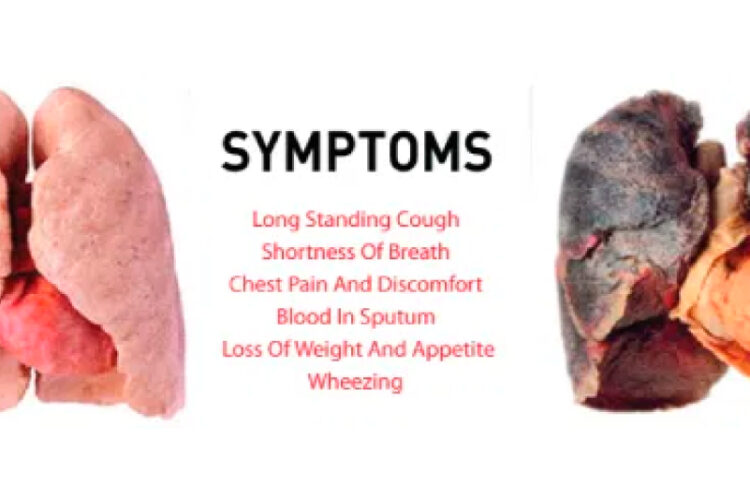 Symptoms of Lung Cancer