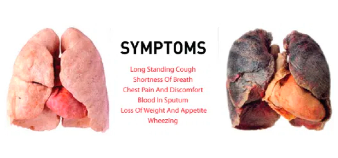 Symptoms of Lung Cancer Symptoms of Lung Cancer